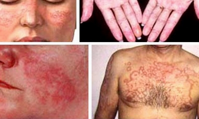 Lupus ban đỏ gây tổn thương nhiều cơ quan.jpg